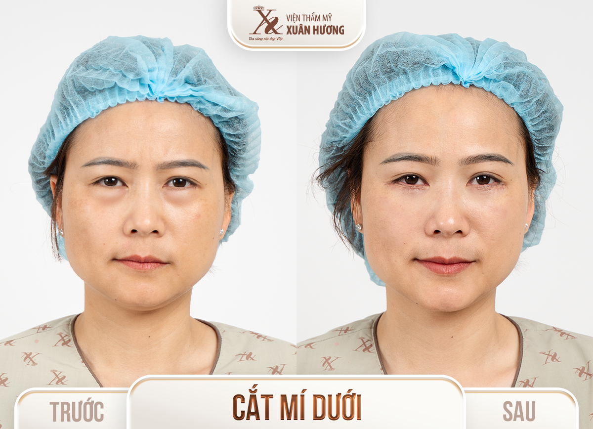 Ảnh trước sau – Phẫu thuật thẩm mỹ