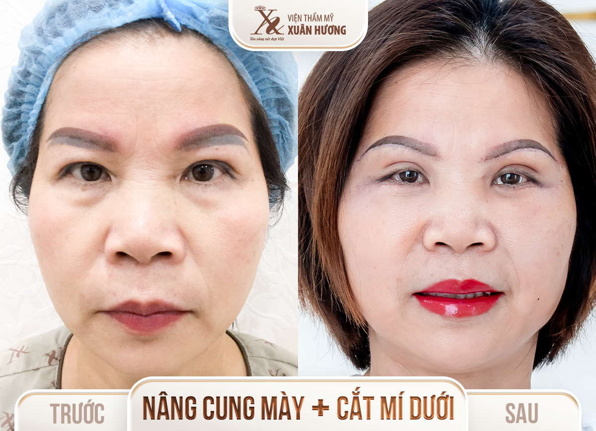 Ảnh trước sau – Phẫu thuật thẩm mỹ