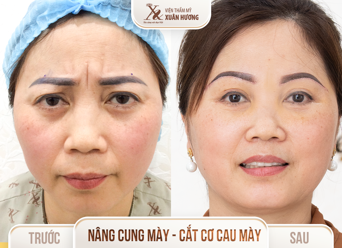 Ảnh trước sau – Phẫu thuật thẩm mỹ