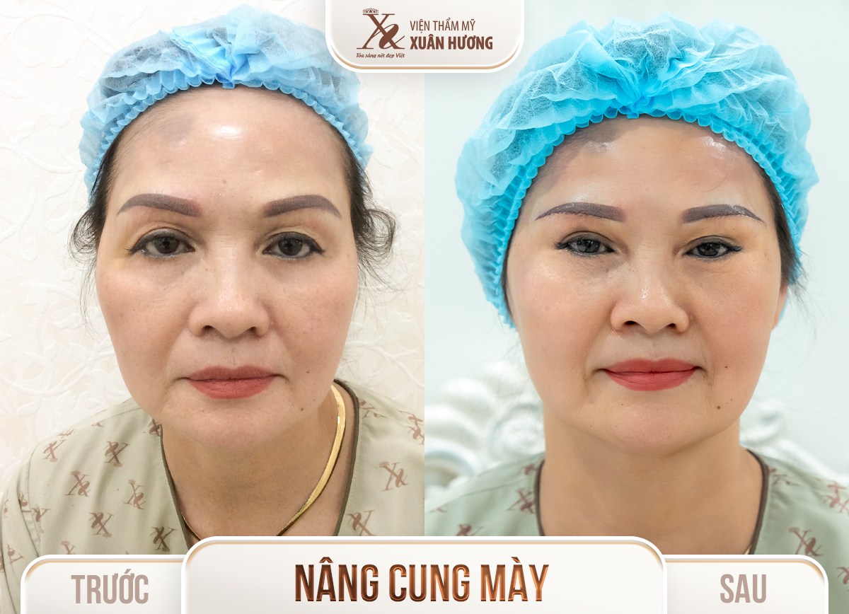 Ảnh trước sau – Phẫu thuật thẩm mỹ