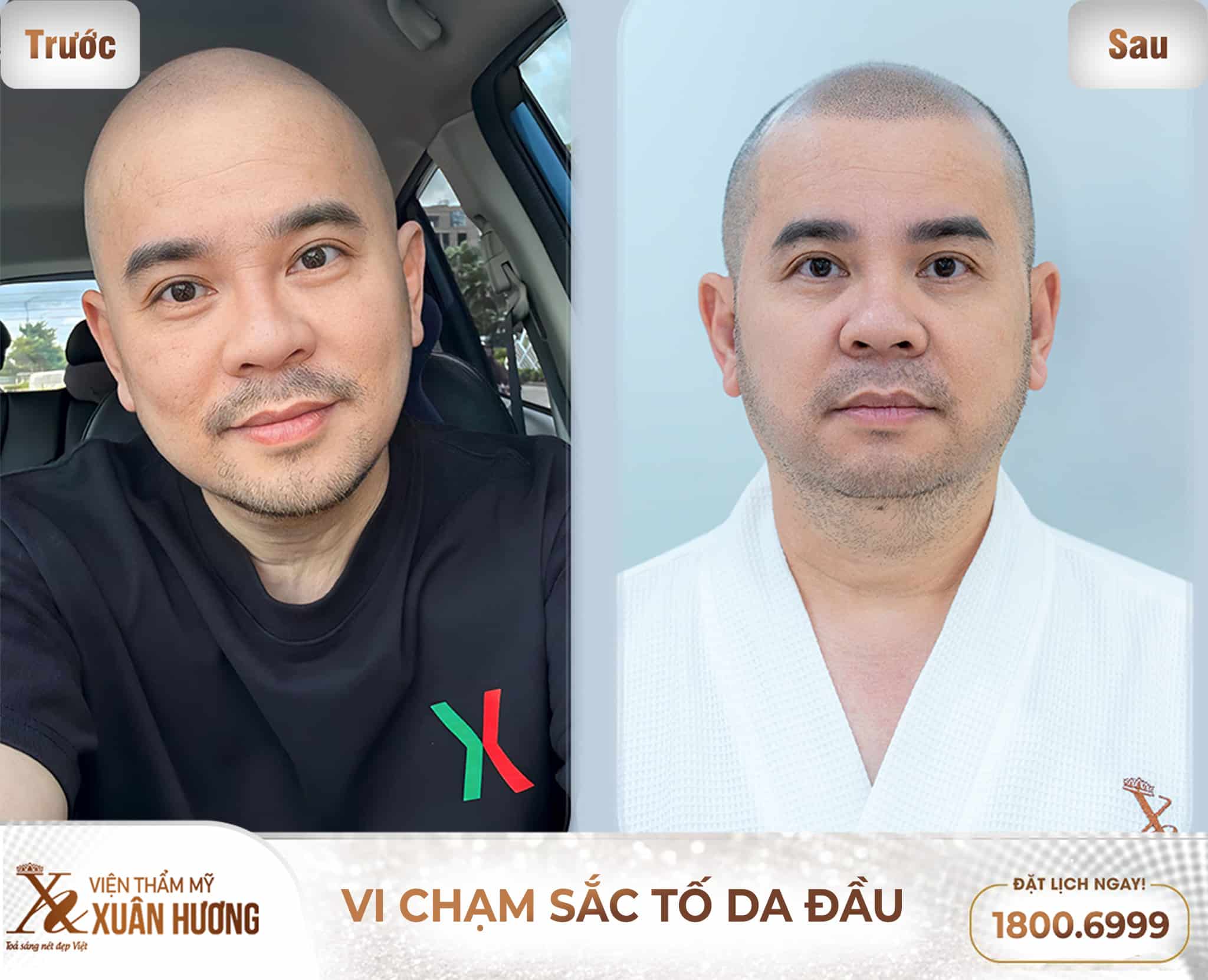 doanh nhân dương quốc nam vi chạm sắc tốc da đầu