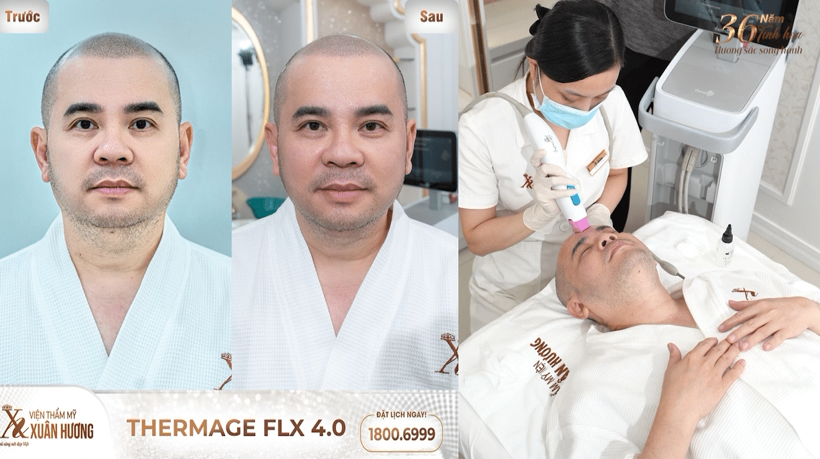 doanh nhân dương quốc nam làm Thermage FLX 4.0