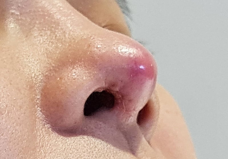dấu hiệu nâng mũi bị tụt