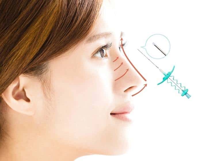 thực hiện nâng mũi chỉ như thế nào