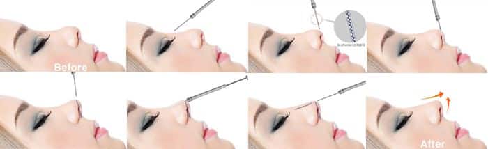 quy trình thực hiện nâng mũi chỉ